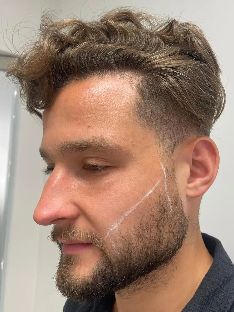 Transplantacja brody - Zaznaczony obszar - Profil lewy