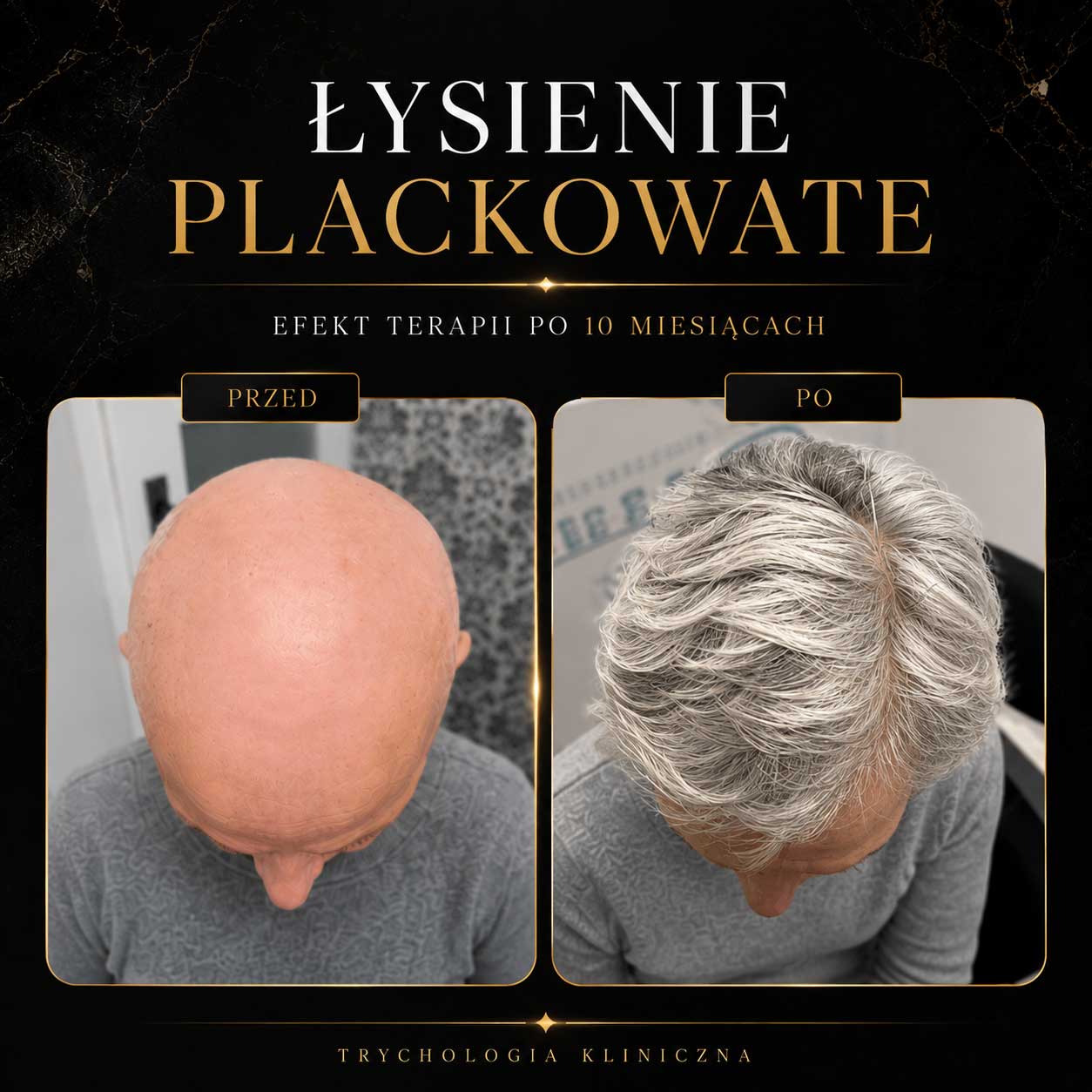 Łysienie plackowate