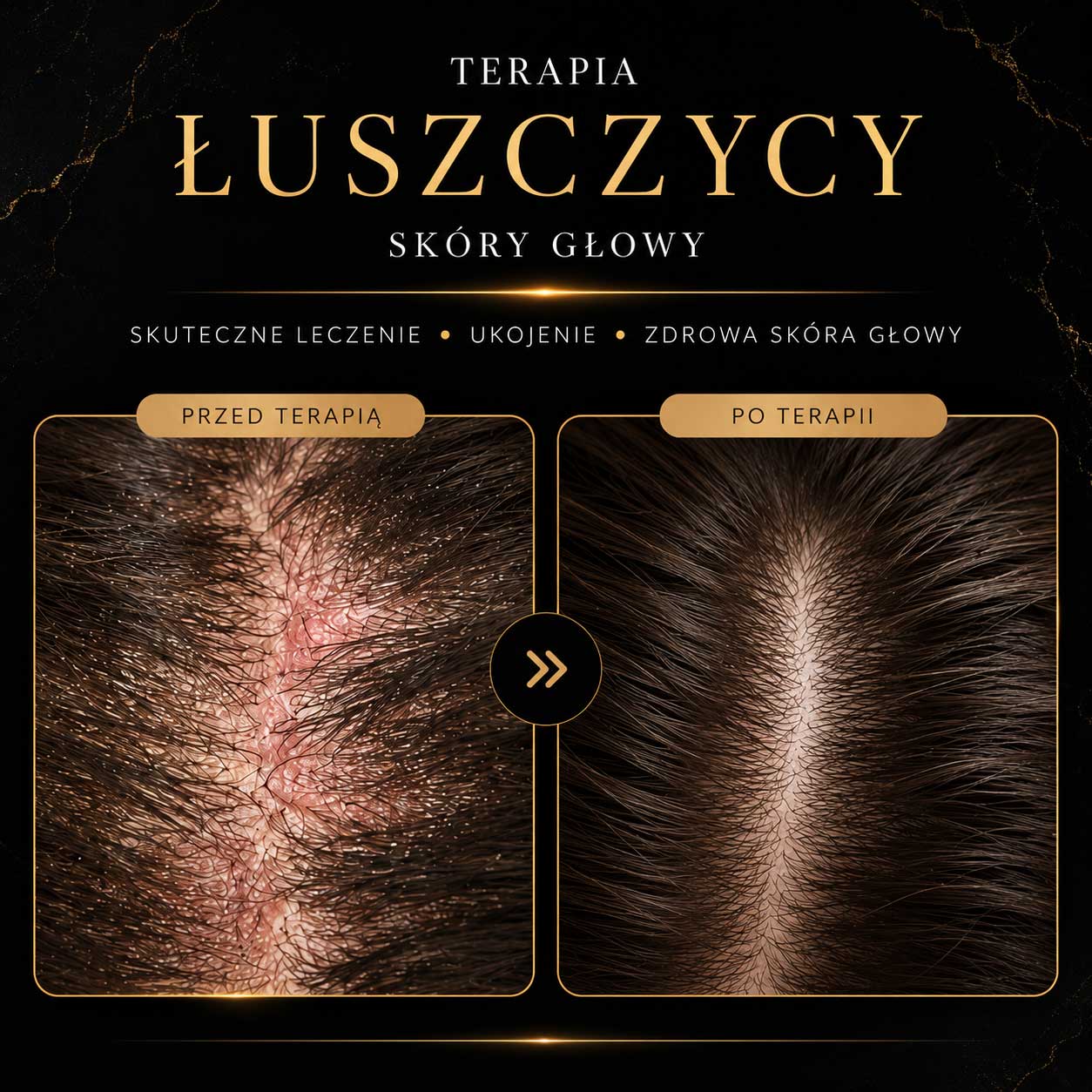 Terapia łuszczycy